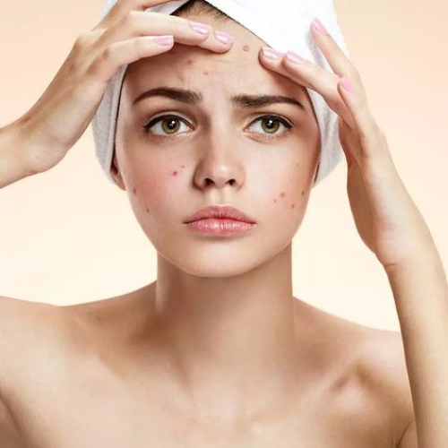 Acne care